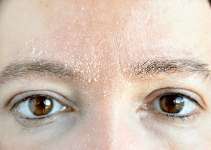 Collagen và tác dụng của nó đối với cơ thể và sắc đẹp 10 Xử lý tác hại của ánh nắng mặt trời