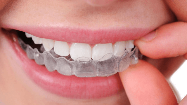 Cách làm trắng răng tại nhà với than hoạt tính thực hiện ra sao?