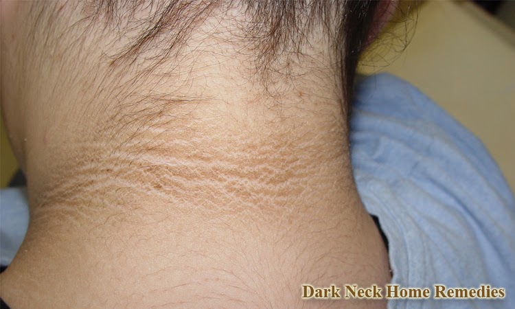 Bộ chăm sóc da cổ - ngực - giảm nhăn - dưỡng trắng. 8 Home Remedies for Dark Neck