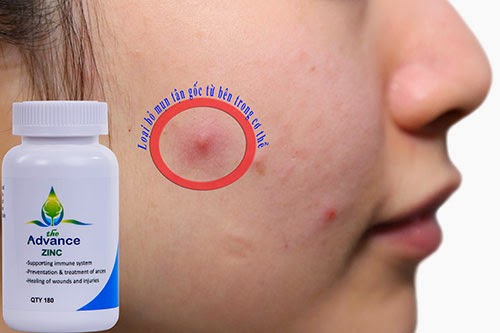 Zinc kẽm gluconat 70mg trị mụn - ngăn ngừa mụn từ bên trong 15 tri mun tan goc zinc