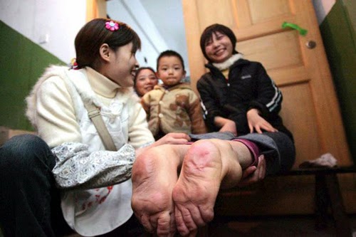 Làm Sao đi được Với Bàn Chân Ngược Lên Trời Như Thế Này