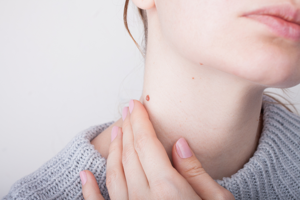 Girl,with,birthmarks,on,the,neck