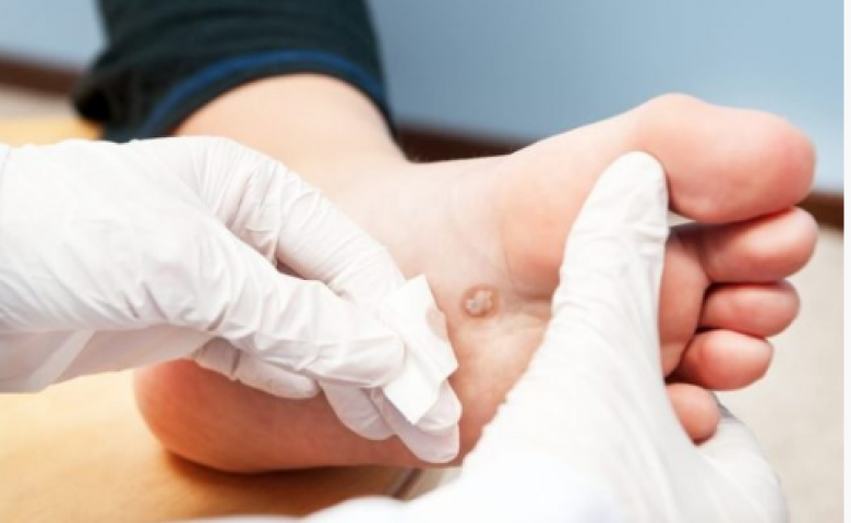 Phương Pháp Trị Mụn Cóc Hữu Hiệu (1)