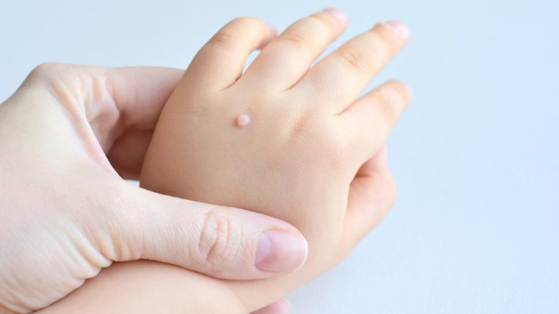 Phương Pháp Trị Mụn Cóc Hữu Hiệu