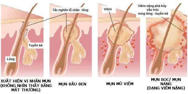 Trị mụn an toàn - Giải pháp hiệu quả cho làn da của bạn