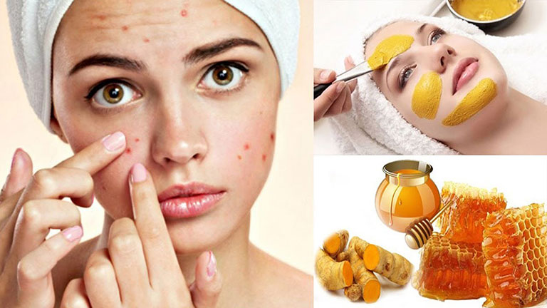 Trị-mụn-bằng-nghệ-tươi-tại-nhà