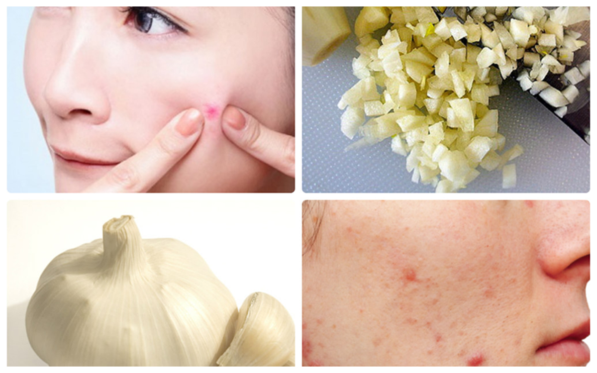 Trị-mụn-bằng-tỏi-tại-nhà