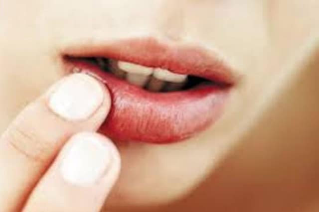 Top những loại thuốc trị nhiệt miệng hiệu quả nhất hiện nay 3 thuốc trị nhiệt miệng hiệu quả nhất