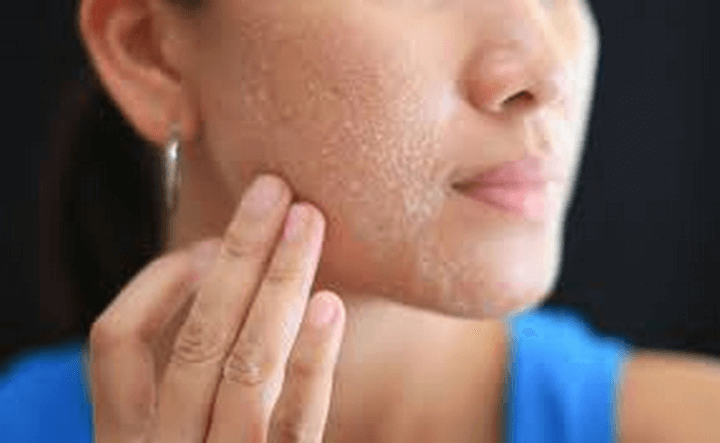 Vì sao mùa đông da dễ bị khô?