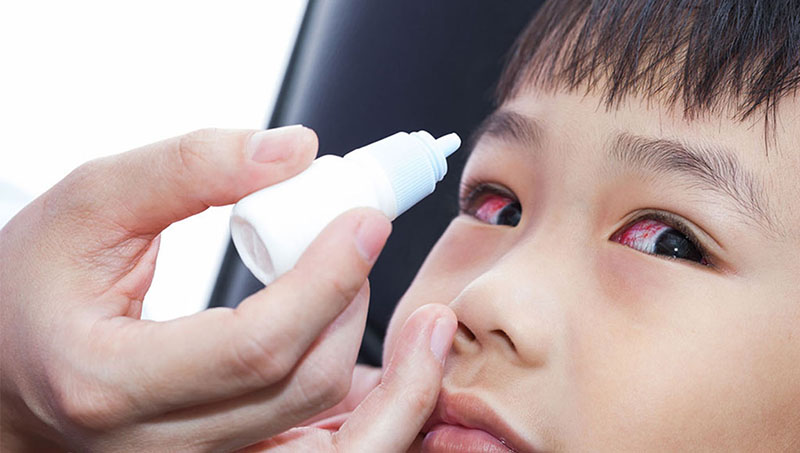 Cách trị đau mắt đỏ tham khảo & lời khuyên