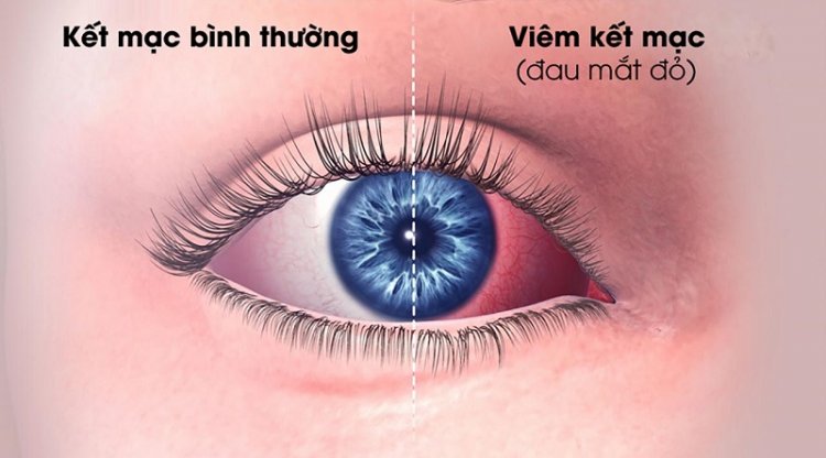 Cách trị đau mắt đỏ tham khảo & lời khuyên