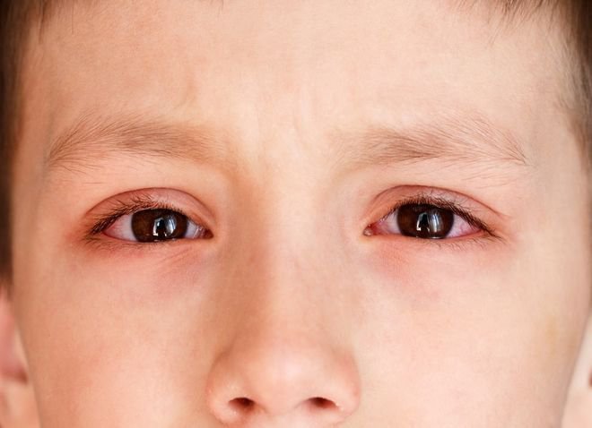 Cách trị đau mắt đỏ tham khảo & lời khuyên