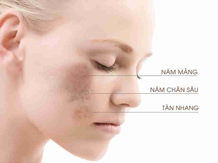 Cách Trị Nám Da Mặt Tại Nhà Từ Nguyên Liệu Thiên Nhiên