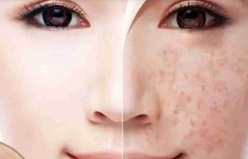 Cách Trị Nám Da Mặt Tại Nhà Từ Nguyên Liệu Thiên Nhiên