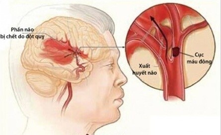 Đột quỵ một vấn đề cấp bách chúng ta cần quan tâm 12 Đột quỵ một vấn đề cấp bách chúng ta cần quan tâm