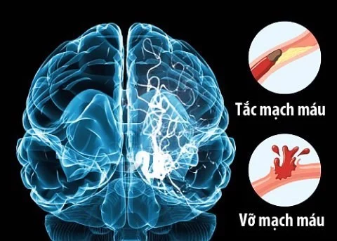 Đột quỵ một vấn đề cấp bách chúng ta cần quan tâm 9 Đột quỵ một vấn đề cấp bách chúng ta cần quan tâm