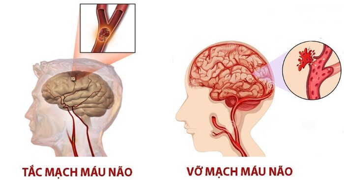 Đột quỵ một vấn đề cấp bách chúng ta cần quan tâm 3 Đột quỵ một vấn đề cấp bách chúng ta cần quan tâm