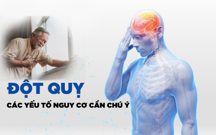 Đột quỵ một vấn đề cấp bách chúng ta cần quan tâm 2 Đột quỵ một vấn đề cấp bách chúng ta cần quan tâm