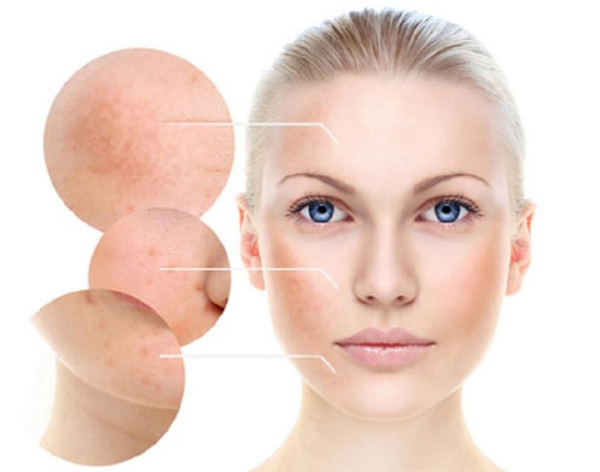 Một số phương pháp trị nám tàn nhang làm đẹp da dễ làm