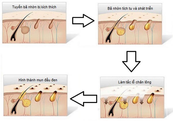 Nguyên nhân thâm nách cùng cách xử lý