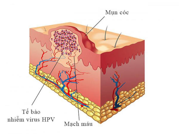 Nguyên nhân thâm nách cùng cách xử lý