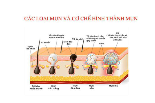 Nguyên nhân thâm nách cùng cách xử lý