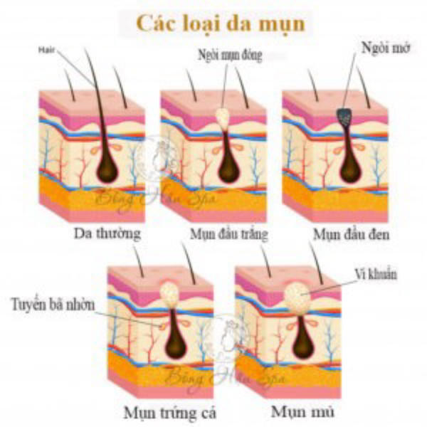 Nguyên nhân thâm nách cùng cách xử lý