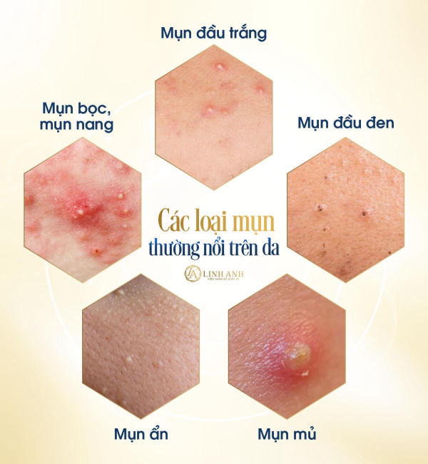 Nguyên nhân thâm nách cùng cách xử lý