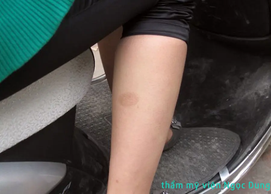 SWITCH Phuong phap xoa vet tham bong bo mot