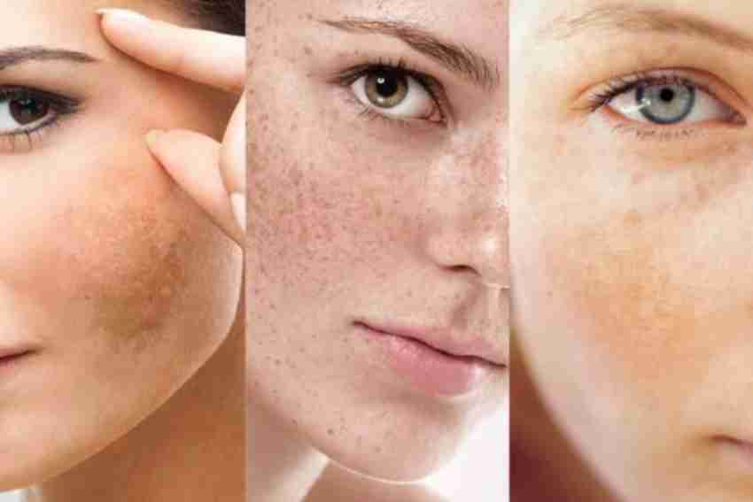 Tàn Nhang Và Cách Loại Bỏ Tàn Nhang Hiệu Quả