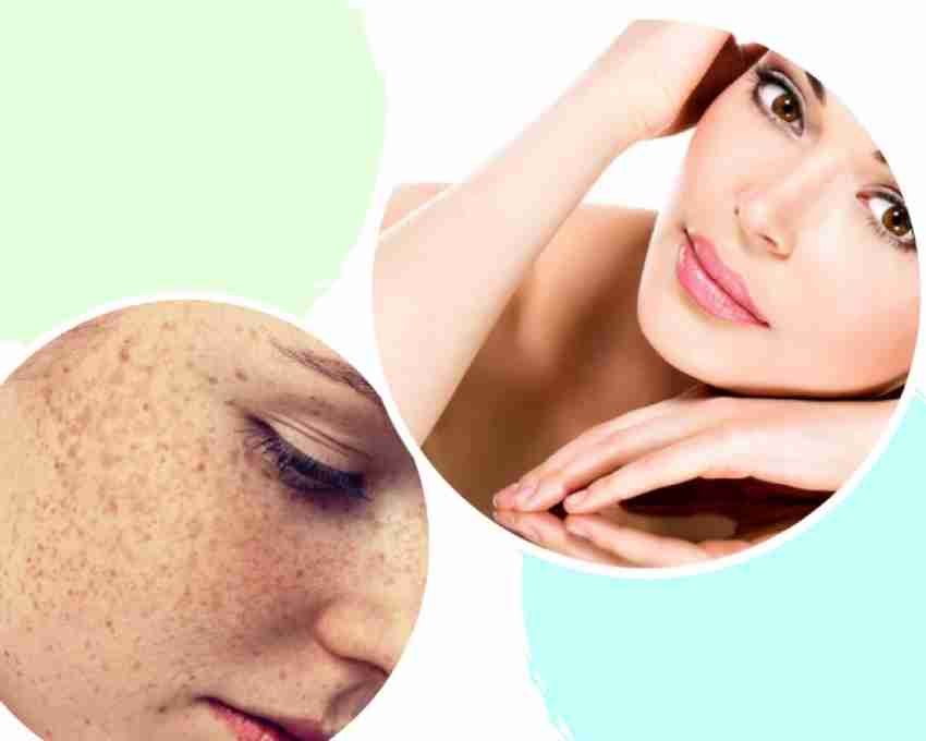 Tàn Nhang Và Cách Loại Bỏ Tàn Nhang Hiệu Quả