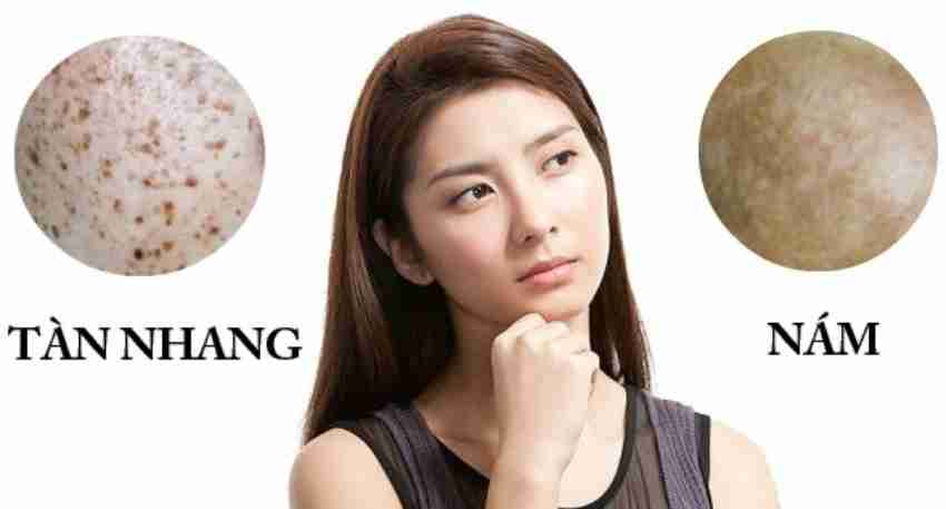 Tàn Nhang Và Cách Loại Bỏ Tàn Nhang Hiệu Quả