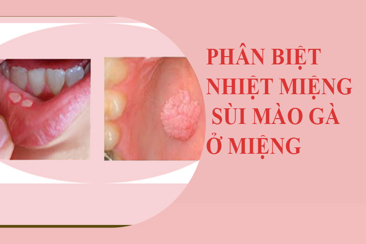 Top những loại thuốc trị nhiệt miệng hiệu quả nhất hiện nay 7 Top Những Loại Thuốc Trị Nhiệt Miệng Hiệu Quả Nhất Hiện Nay