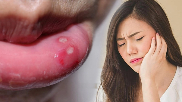 Top những loại thuốc trị nhiệt miệng hiệu quả nhất hiện nay 6 Top Những Loại Thuốc Trị Nhiệt Miệng Hiệu Quả Nhất Hiện Nay
