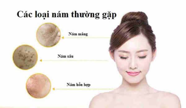 Vài cách trị nám đơn giản nhưng vô cùng hiệu quả 13 Vài cách trị nám đơn giản nhưng vô cùng hiệu quả