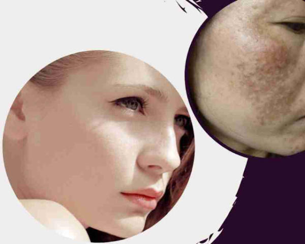 Vài cách trị nám đơn giản nhưng vô cùng hiệu quả 21 Vài cách trị nám đơn giản nhưng vô cùng hiệu quả