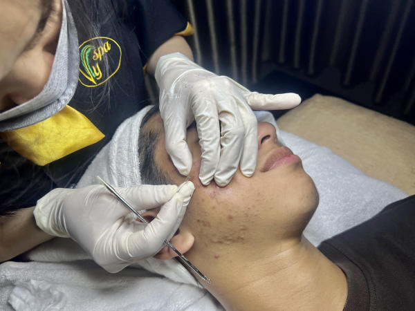 Phương pháp trị sẹo rỗ tại các spa uy tín