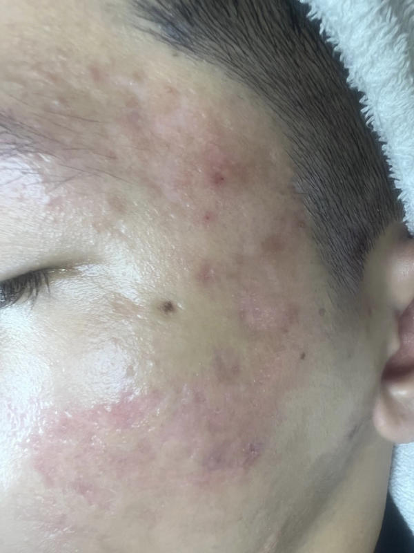 G13 Đường 3A, Phường Tân Hưng, Quận 7, Thành phố Hồ Chí Minh 700000 Vy Spa 4 trị mụn và cách trị mụn hiệu quả an toàn