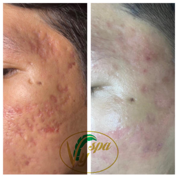 trị mụn và cách trị mụn hiệu quả an toàn