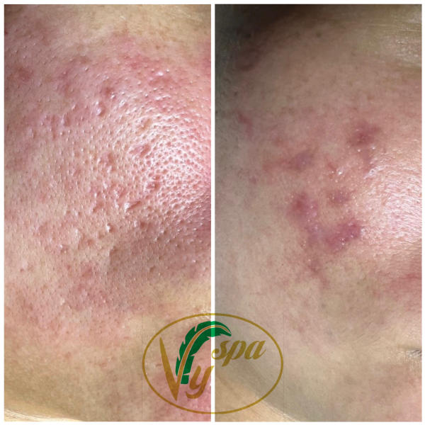 trị mụn và cách trị mụn hiệu quả an toàn