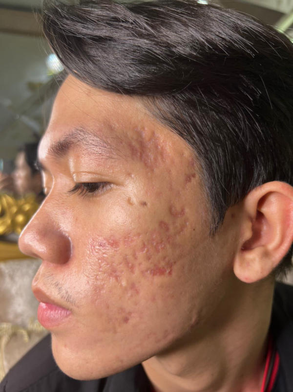 trị mụn và cách trị mụn hiệu quả an toàn