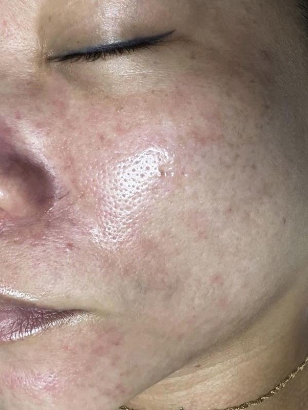 trị mụn và cách trị mụn hiệu quả an toàn